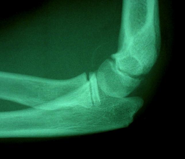 Nearly all of these fractures are displaced, owing to the paucity of soft tissue attachments.