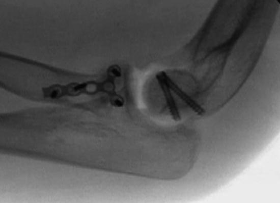 OUTCOMES Good to excellent outcomes have been reported for more than 90% of patients with ORIF, particularly when the fracture is isolated to the radio-capitellar compartment.