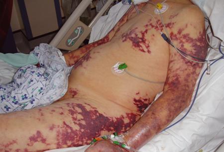 "sepsis" Originating from the Latin and Greek terms gangreana,