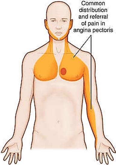 exertion. Angina pectoris pain is a classic example of the accumulation of P factor in a muscle.