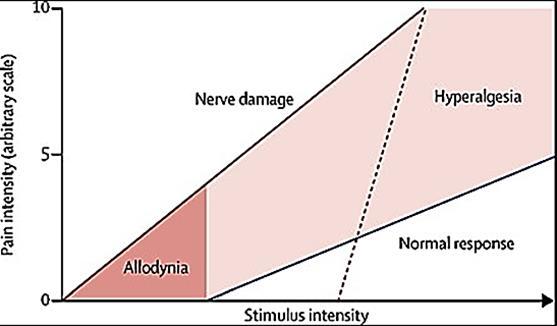 Pain hypersensitivity takes two forms: A. allodynia: thresholds are lowered so that stimuli that would normally not produce pain now begin B.