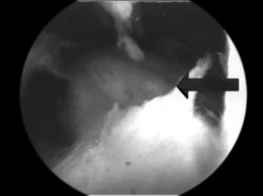impingement in the patellofemoral compartment; (D) hypertrophied synovitis in the knee joint. In group II, five patients had synovitis and 10 had fibrotic tissue. The mean preoperative ROM was 48.
