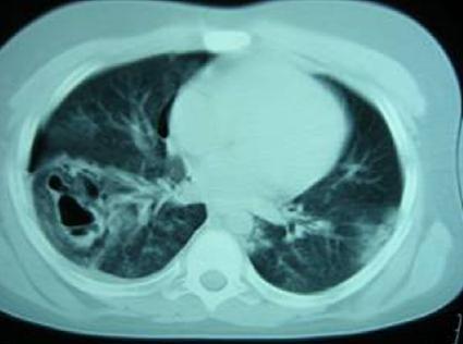 CT will also accurately determine the true extent of a pulmonary contusion which will not be apparent on plain radiography alone.