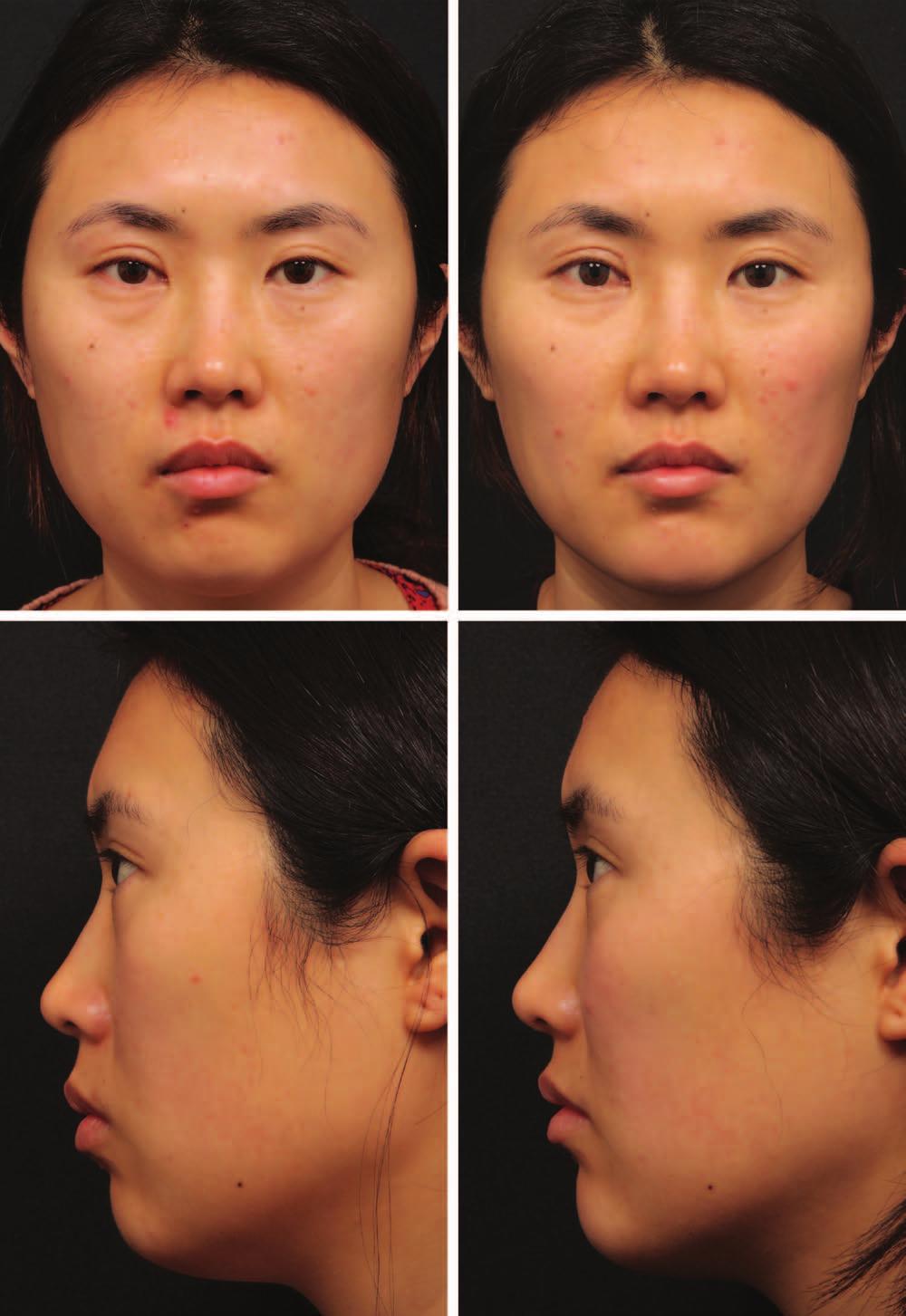 Plastic and Reconstructive Surgery November Supplement 2015 Fig. 2. (Left) A young Asian woman with wide face and flat midline facial structures secondary to the intrinsic Asian skeletal structures.