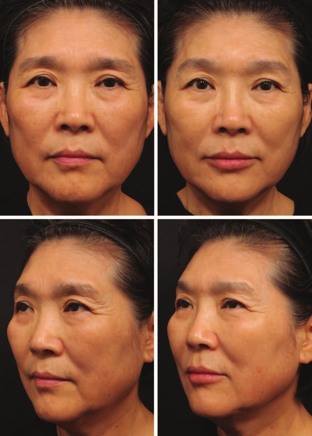 Volume 136, Number 5S Use of Facial Injectables in Asian Patients Fig. 3. ( Left) A 65-year-old Asian woman with wide and square facial shape.