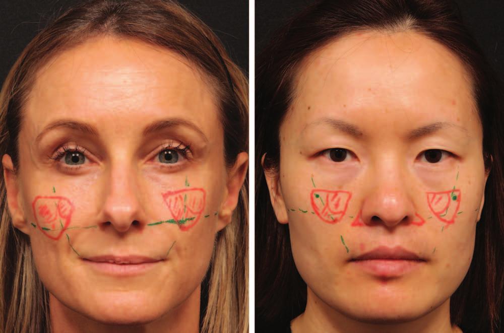 Plastic and Reconstructive Surgery November Supplement 2015 Fig. 4. (Left) Volumization of the midface in a 40-year-old white woman.