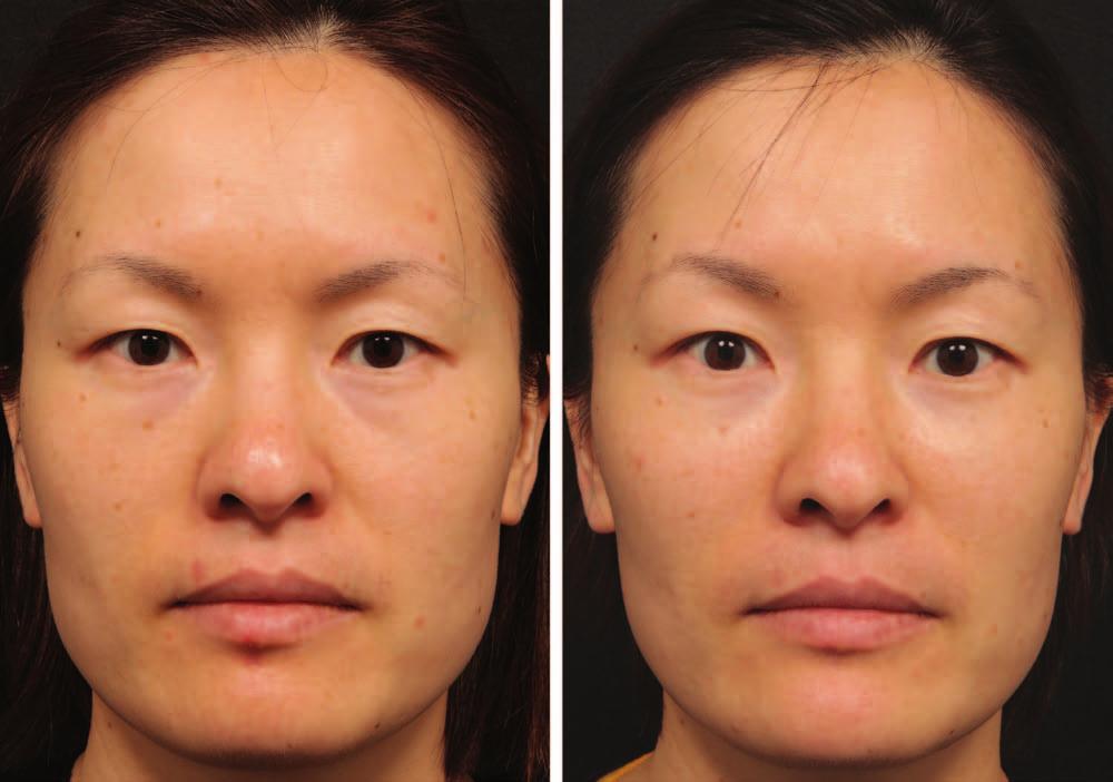 Note the bulk of dermal filler to be placed in the medial half of the maxilla to provide central projection. Fig. 5. (Left) A 39-year-old Asian woman with a short square face.