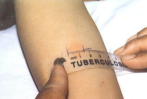 Confirming the presence of TB co-infection In co-infection, sputum specimens are often negative. Tuberculin skin tests may be affected by an impaired immune response and show as negative.
