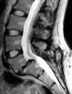 Lumbar Spine (Axial 3D Hyce)