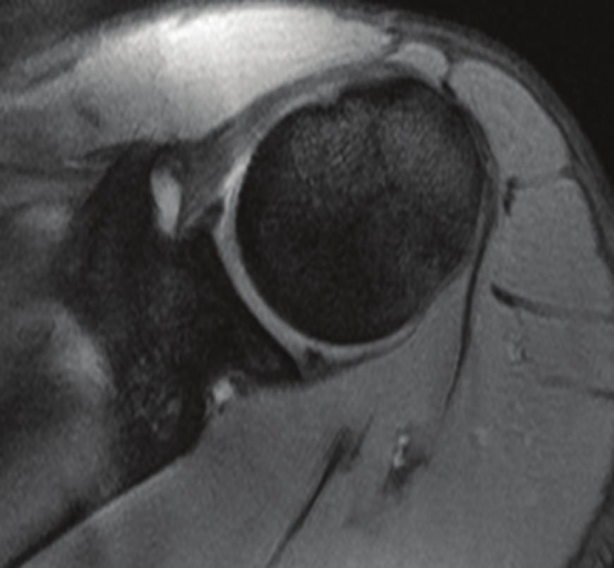 more common diagnosis of a biceps tear.