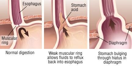 Prolonged exposure to acid can cause the esophagus to: Become inflamed Narrow Develop an open sore Long-term exposure to acid also can lead to a condition called Barrett's esophagus.
