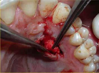 mucogingival junction so as to relax the flap sufficiently to allow placement of the connective tissue graft.