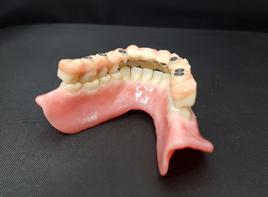2 ORAL FREEDOM: HYBRID PROSTHESES ARE BEST LINGUALIZED MDT HENRYK JURZYCA Abutment teeth and implants do not tolerate horizontal forces over the long term very well.