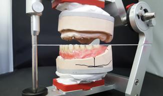 3 THE PATIENT Male, 65 years old, full denture wearer As is often the case, the patient has experienced many years of suffering due to a lack of retention of the upper and lower jaw prostheses.