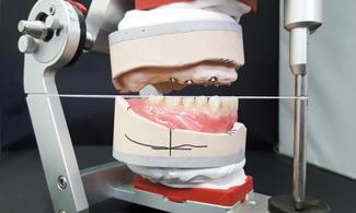 After clinical and radiographic findings indicated that the prerequisites for implant restoration in the upper jaw were satisfied (Camlog), the patient opted for an upper jaw hybrid denture and a