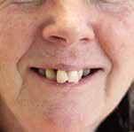 CASE STUDY Karen, Immediate Denture Karen s teeth affected her confidence for many years.