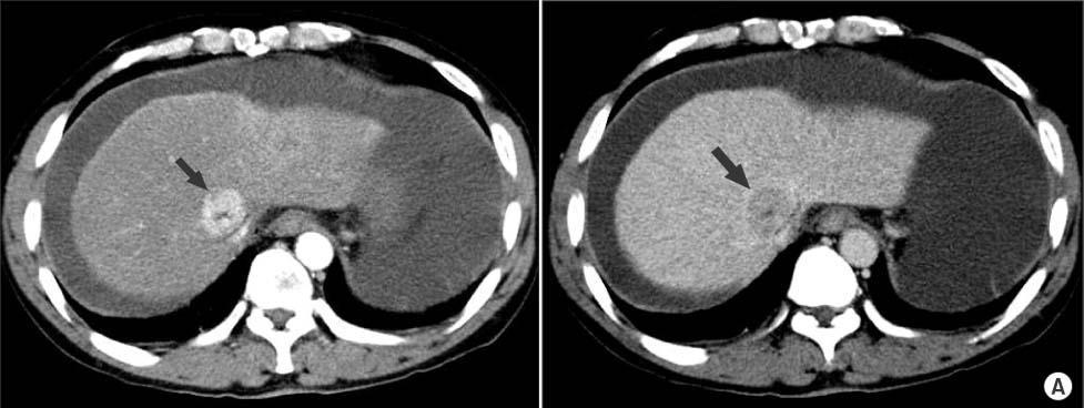 Quad phase CT Appearance of HCC Arterial Phase Arterial Phase Portal