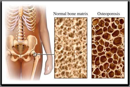 SCI and Osteoporosis Osteoporosis is a disease in which bones become fragile and can break easily.