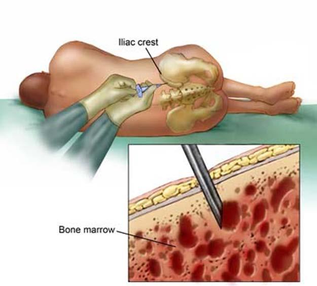 Hematopoietic (blood and bone marrow)