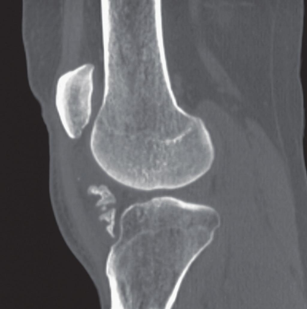 Case Reports in Orthopedics 3 Figure 3: Computed tomography showing the mass with its osseous content in the infrapatellar region. (a) (b) Figure 4: (a) Axial T1-weighted image.