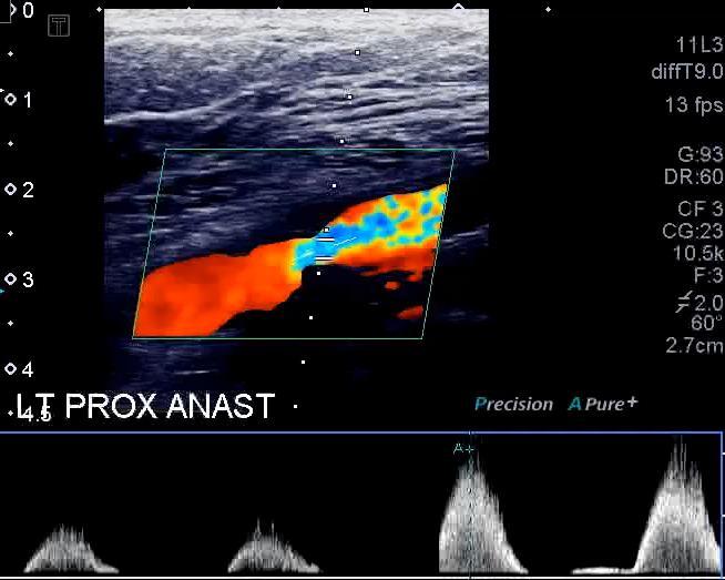 Ax-Fem Bypass Surveillance July ABIs: Right 0.91 Left 0.89 Patient asymptomatic No intervention, follow up in 3 months October ABIs: Right 0.