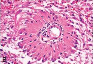 Histopathology Cartwheel - Perivascular orientation of the neoplastic cells, which have