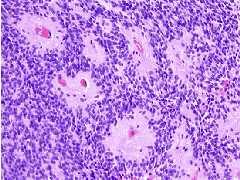 Differential diagnosis Ependymoma Majority infratentorial and