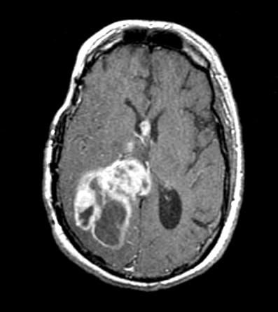 necrosis Enhancing cystic with