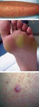 Photosensitivity Alopecia Hand foot skin reaction Seborrheic