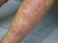 psoriasis Can occur many months after starting therapy Disruption of cytokine balance by TNF blockage