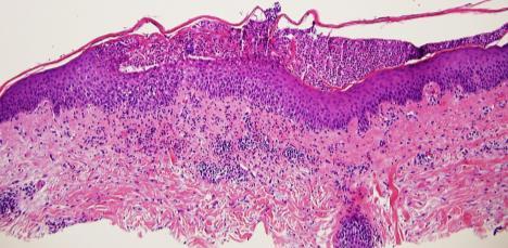Plaque psoriasis (48-57%) Palmoplantar pustulosis (29-45%) Guttate, scalp, pustular, erythrodermic,