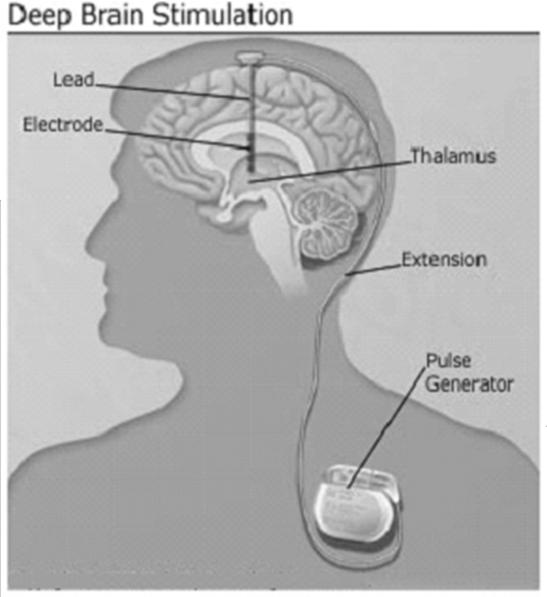 Depending on condition to be treated, stimulating electrodes are implanted in certain areas of the