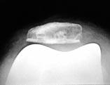 Fig. 1 Patellar view showing patellar subluxation and tilt. Note the asymmetric patellar osteotomy.