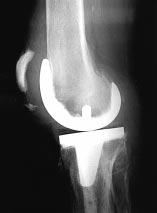 Furthermore, when the transition zone between the trochlear region and the condylar region of the femoral component is abrupt, the localized stress concentration can be quite severe.