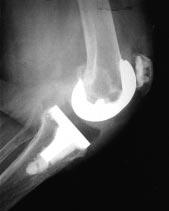 Jess H. Lonner, MD, and Paul A. Lotke, MD V-plasty, quadriceps snip, or tibial tubercle osteotomy should be considered to protect the patellar tendon insertion.
