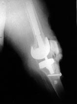 If distal ligament avulsions involve less than 30% of the tibial tubercle insertion, a primary repair of the medial capsuloretinacular sleeve should suffice, without any need for alteration in normal