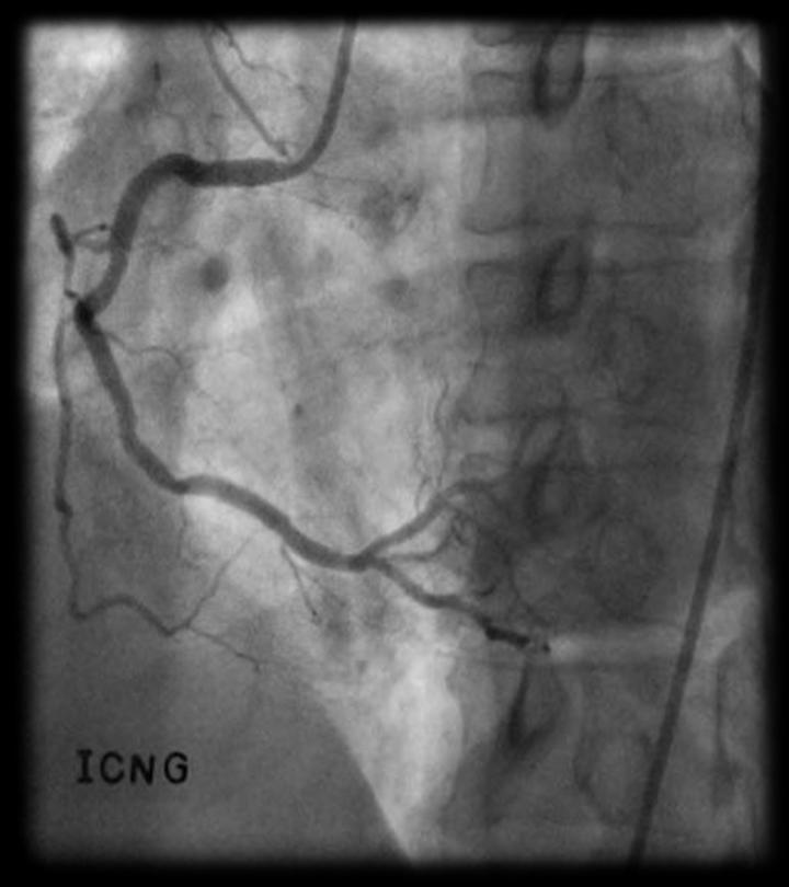 F/56 Stable angina with