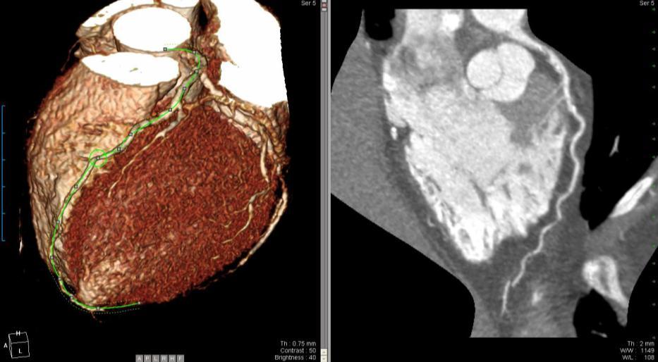 (CT coronary Angiography) Atherosclerosis, definite