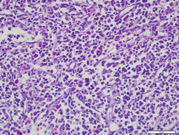 Case Reports in Hematology 3 Figure 3: Polymorphic abnormal cells with atypical medium to large sized mononuclear cells admixed with eosinophil precursors (H&E x40).
