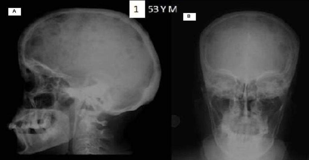Fig. 7: Standard skull x rays (lateral and AP views) to demonstrate the role of standard x ray in the diagnosis and follow up of some cases of multiple myeloma : multiple rounded, well