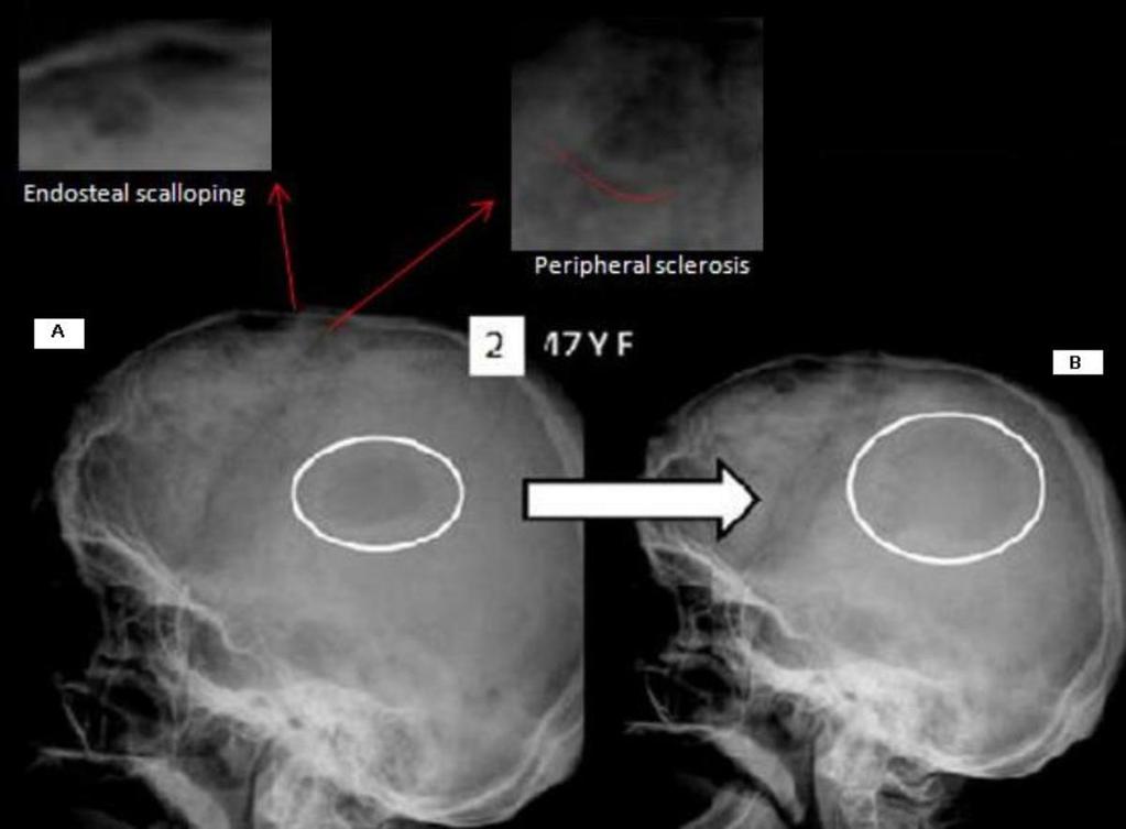 Fig. 8: Standard skull x rays (lateral views) to demonstrate the role of standard x ray in the diagnosis and follow up of some cases of multiple myeloma : multiple rounded, well defined, punched out,