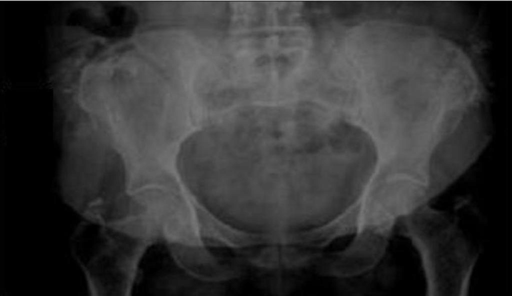 Fig. 9: Pelvic bones of the 46 years female with MM difficulties to discover the
