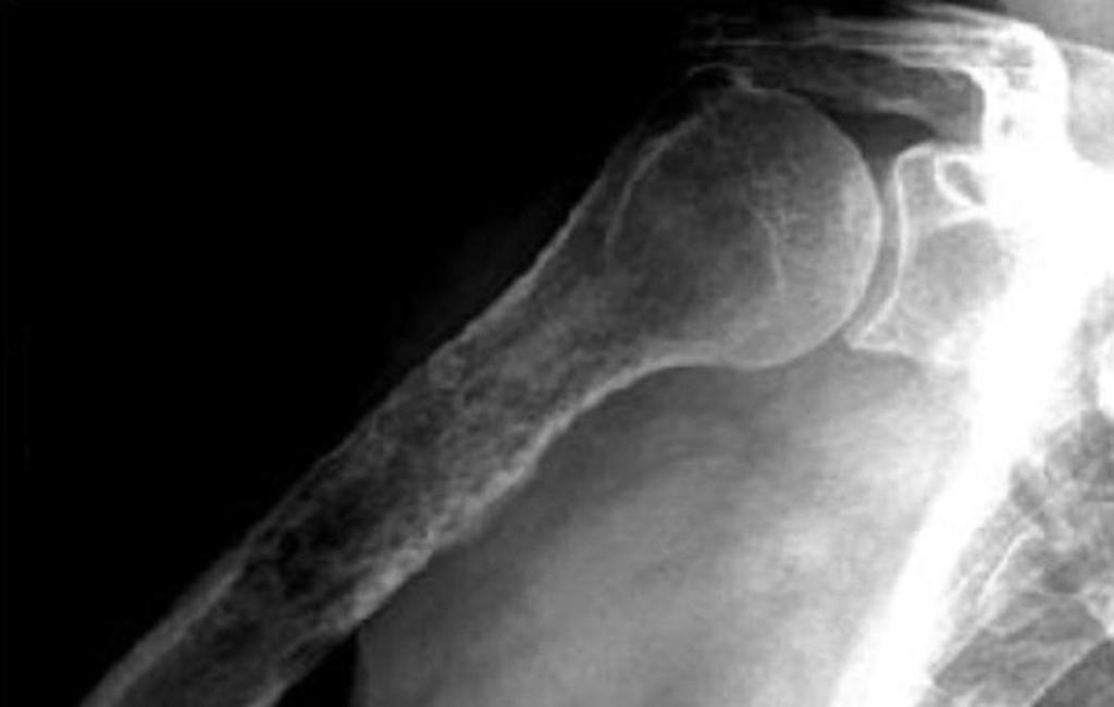 Fig. 11: 43 years male with MM: multiple osteolytic lesions, in the humeral diaphysis some with cortical erosions; difficulty to