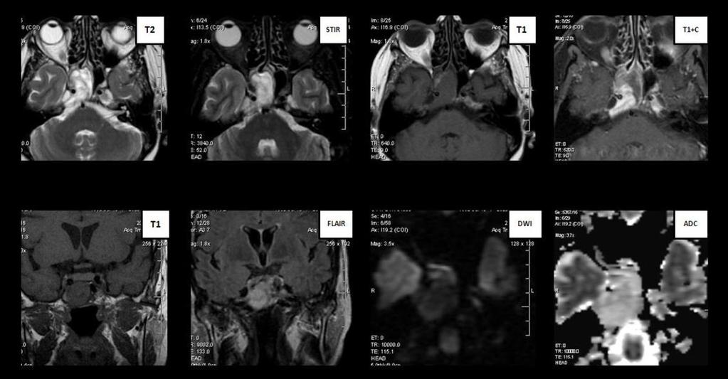 Fig. 14: 60 years old female, MRI of the lumbar spine (T2-A, T1 FS -B, STIR-C) : multiple micronodular vertebral bony lesions like pepper and salt. Fig.