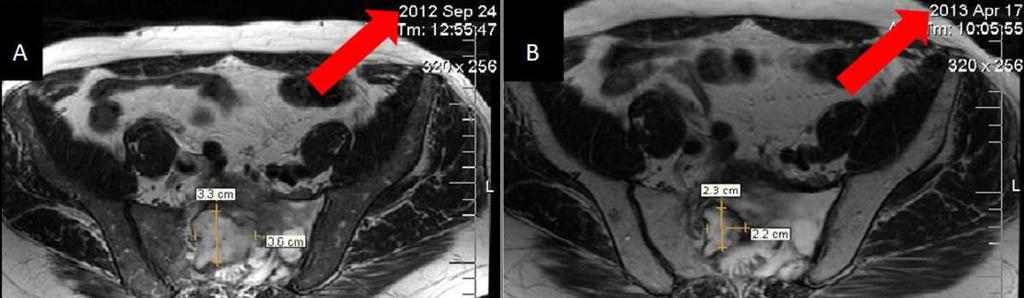 Fig. 19: T2 weighted MRI images (A and B) of the 58 years old male with MM: dimensional regression of the
