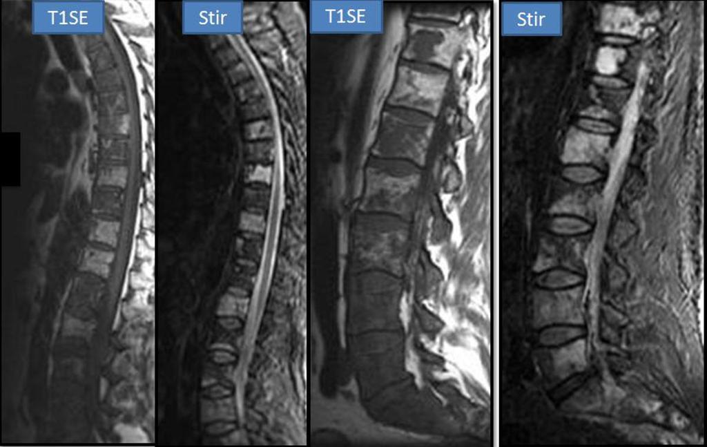 Fig. 25: Patient with Hodgkin disease : Thoracic and lumbar spine MRI : vertebral body lesions