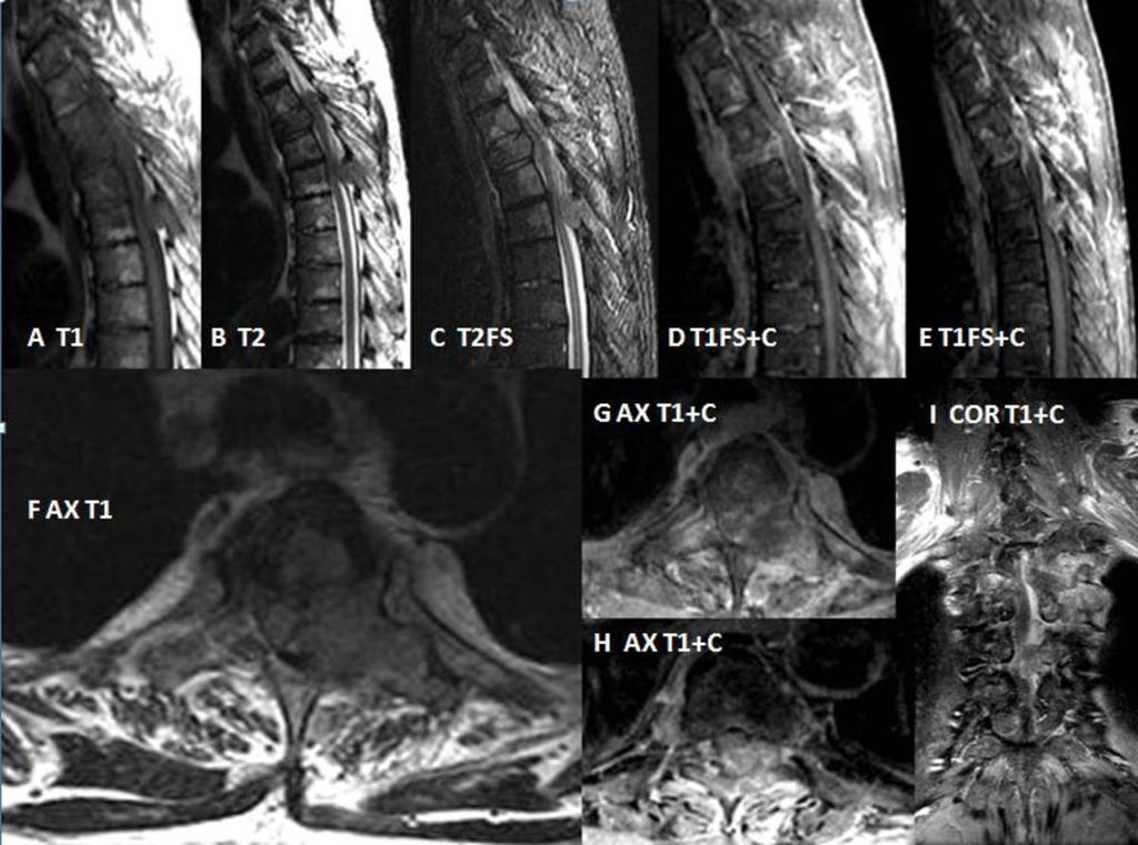 Fig. 26: (A to I) example of young age male spine metastasis from brain with