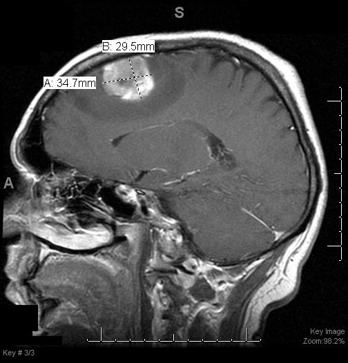 MRI: magnet linked to a computer is used to make detailed pictures of areas in your