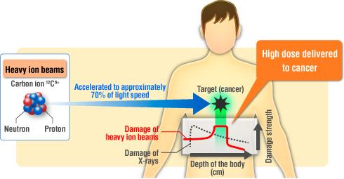 Cancer Treatment: Radiation Highest energy rays are given.