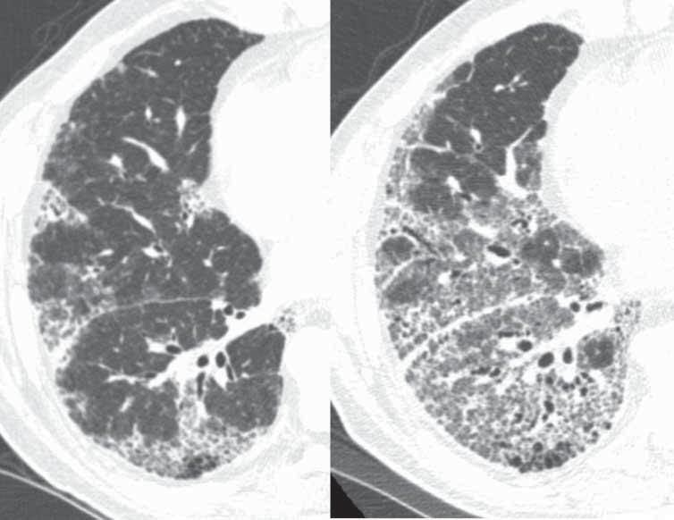 PFTs. Evaluation of patients with acute symptoms Another important role of longitudinal imaging of DLD patients is the evaluation of patients with new or worsening symptoms (figure 4).